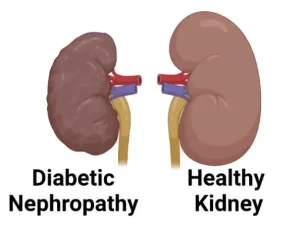 Anatomical diagram comparing a healthy kidney structure with diabetic nephropathy damage